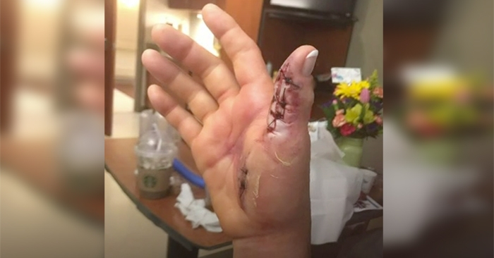 Woman blames nail salon after almost losing arm from flesh-eating bacteria infection