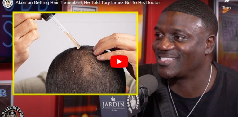 Akon Recalls ‘Painful Part’ of Undergoing $7,500 Hair Transplant in Turkey