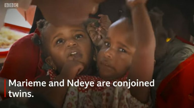 How Can Identical Twins — Including the Conjoined Ndiaye Sisters — Be So Different? What the Science Says